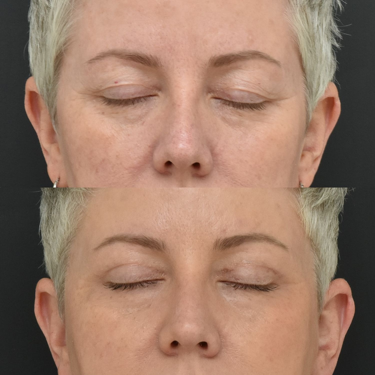 Eyelid Surgery Before & After
