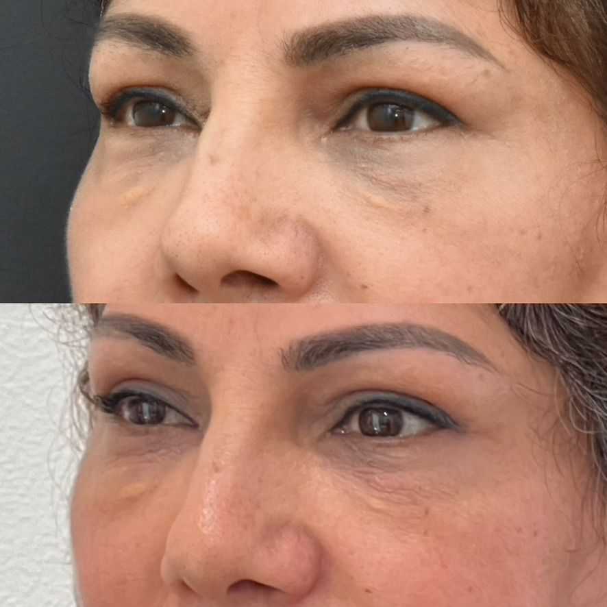 Eyelid Surgery Before & After
