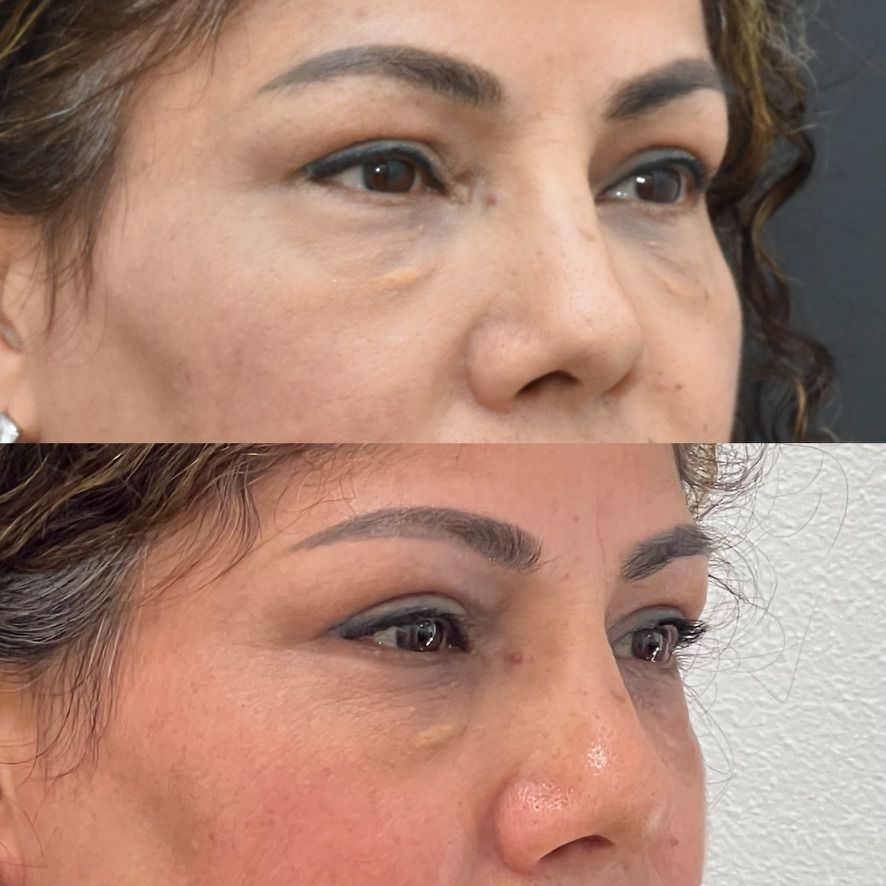 Eyelid Surgery Before & After