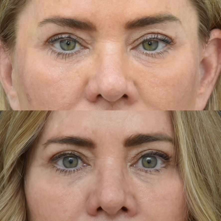 Eyelid Surgery Before & After