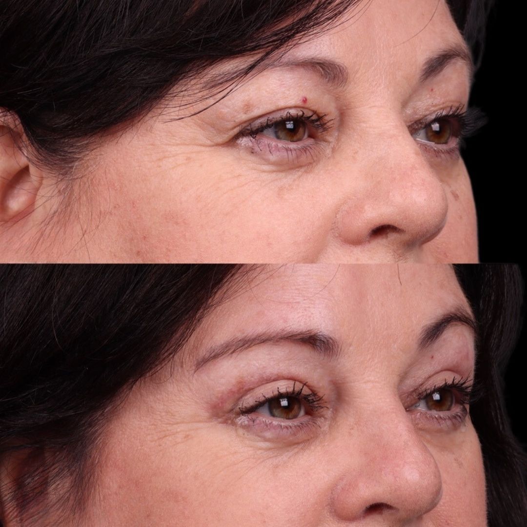 Eyelid Surgery Before & After