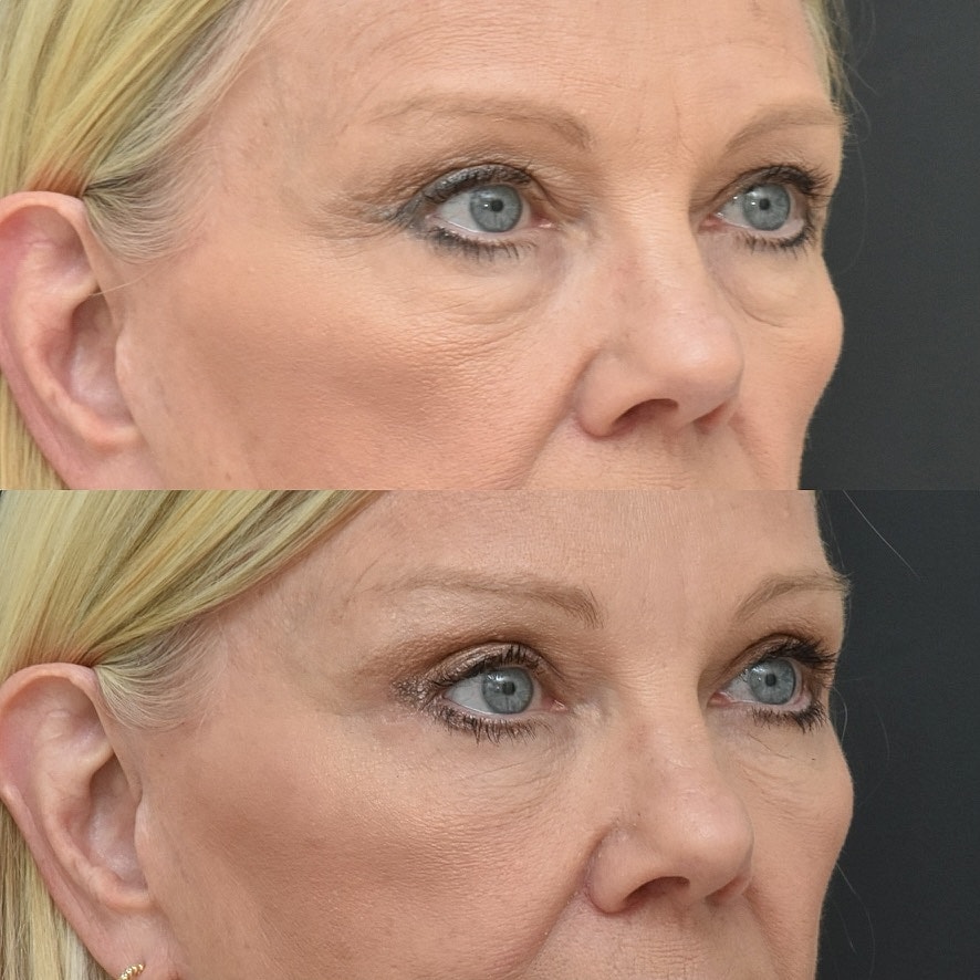 Eyelid Surgery Before & After