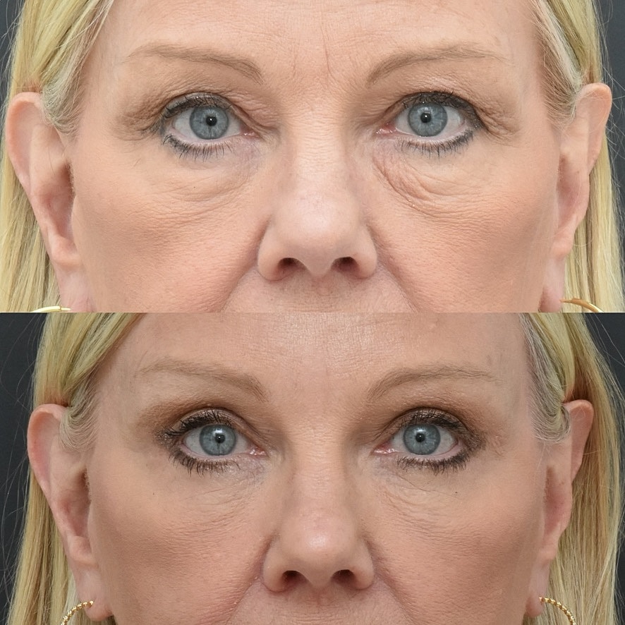 Eyelid Surgery Before & After