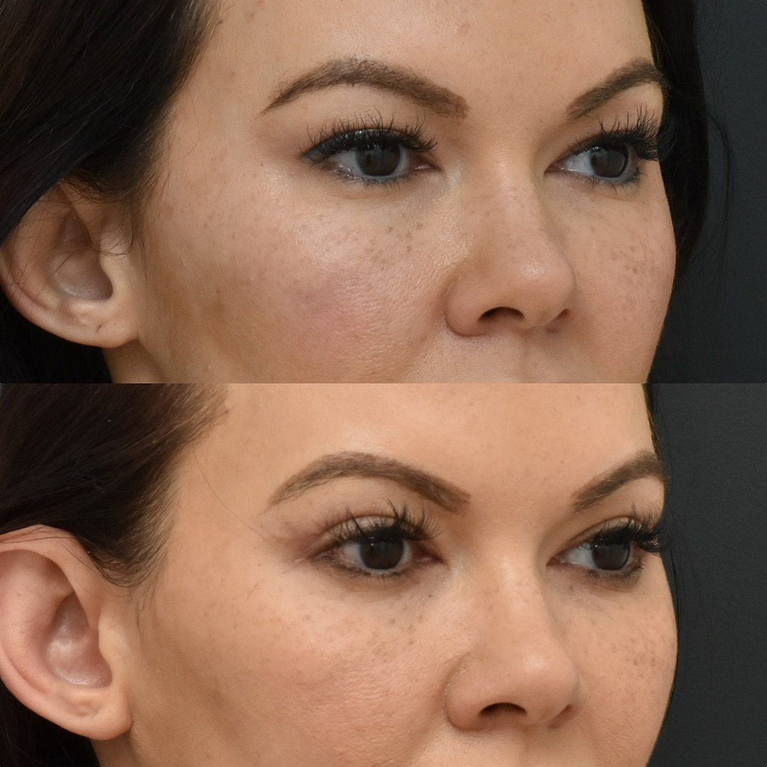 Eyelid Surgery Before & After