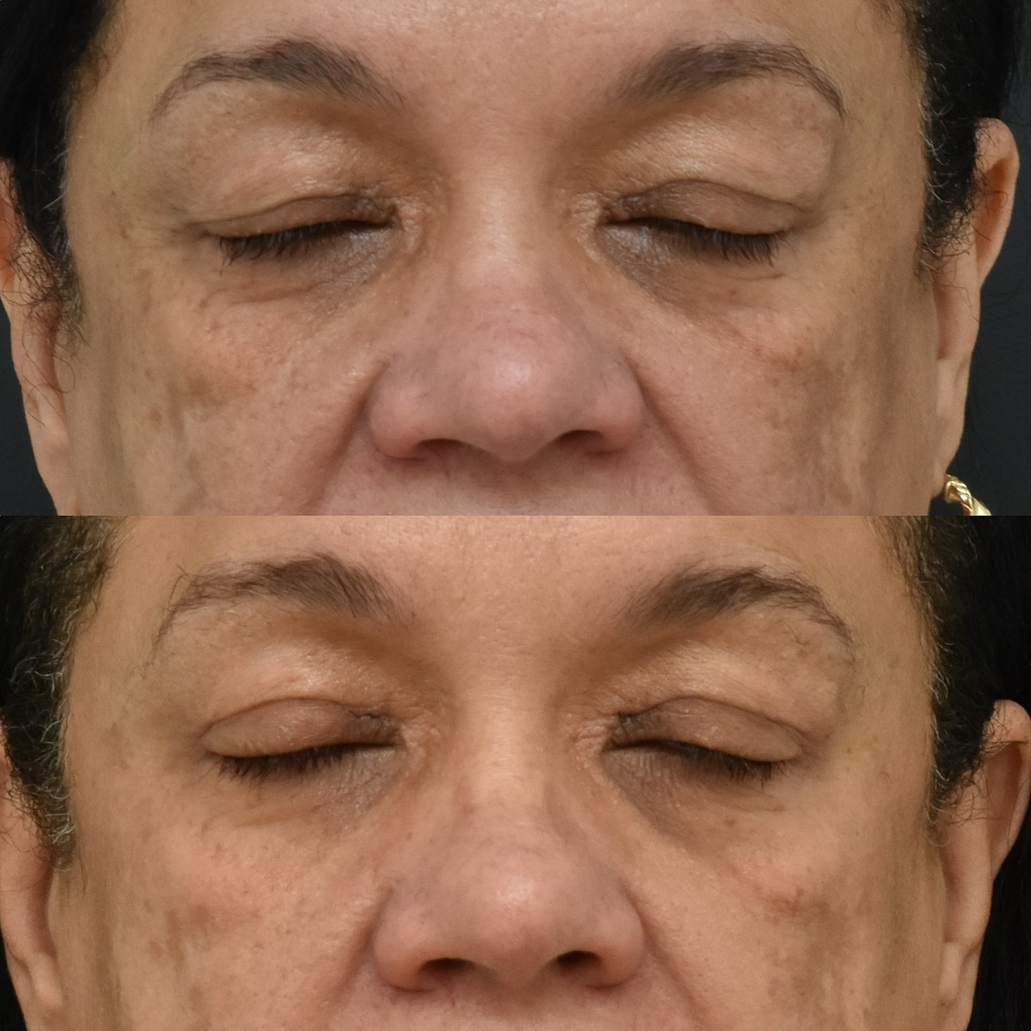 Eyelid Surgery Before & After
