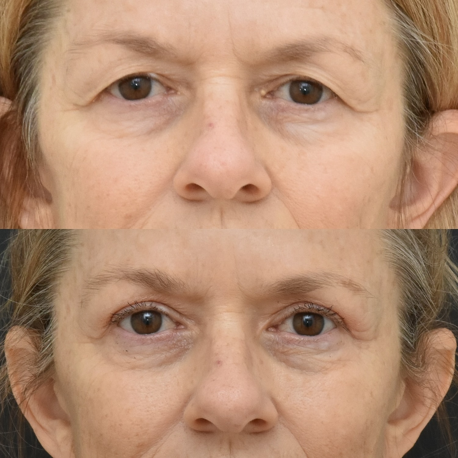 Eyelid Surgery Before & After