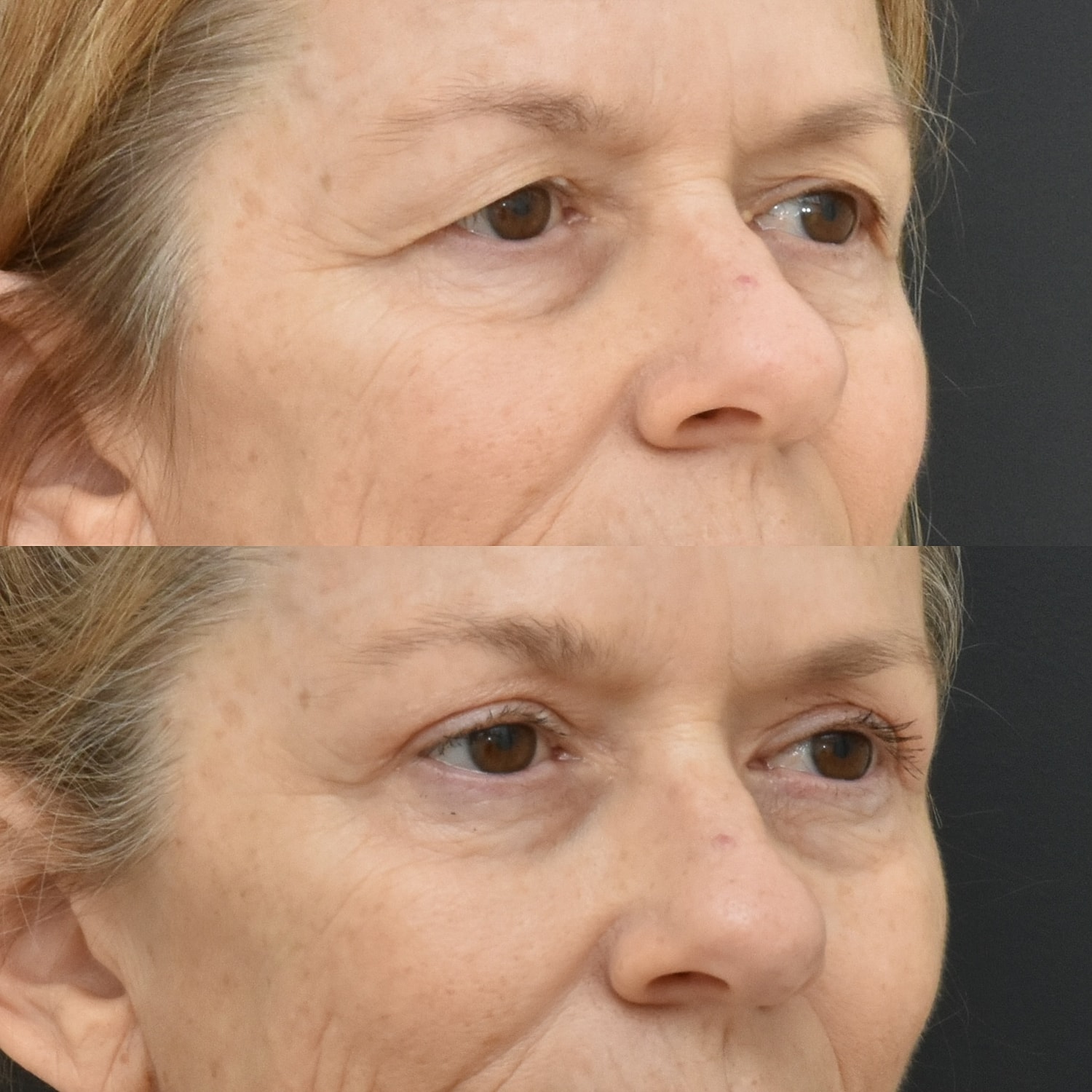 Eyelid Surgery Before & After