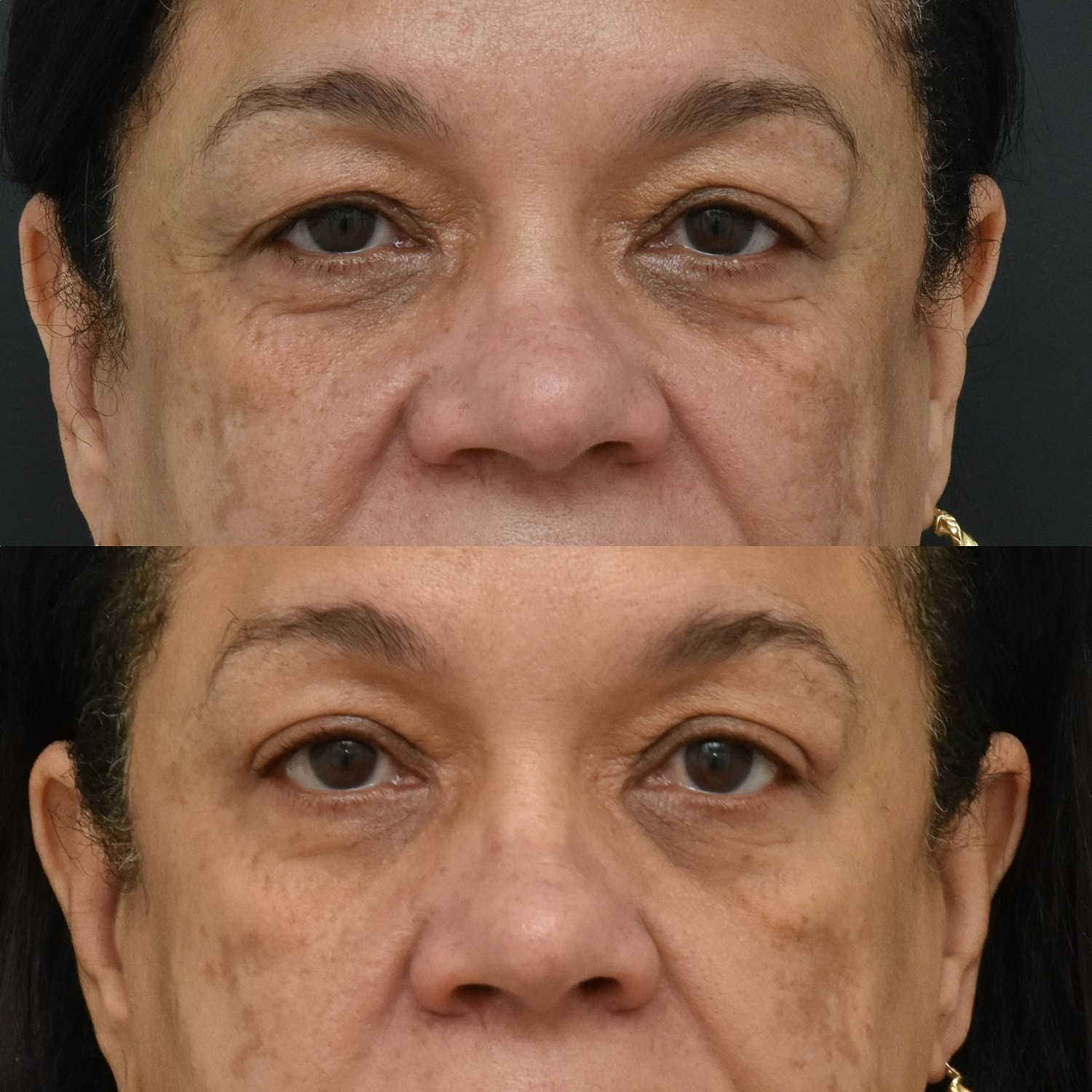 Eyelid Surgery Before & After