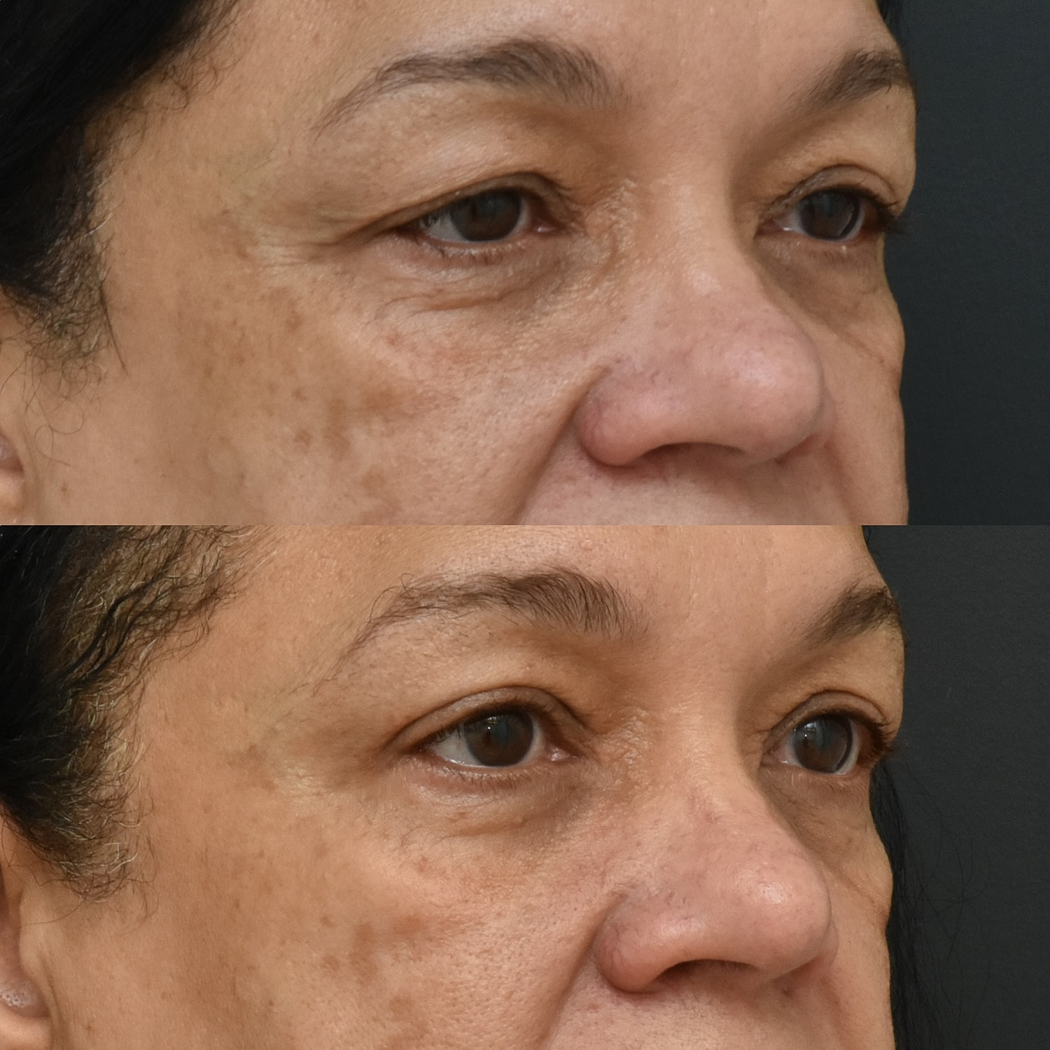 Eyelid Surgery Before & After