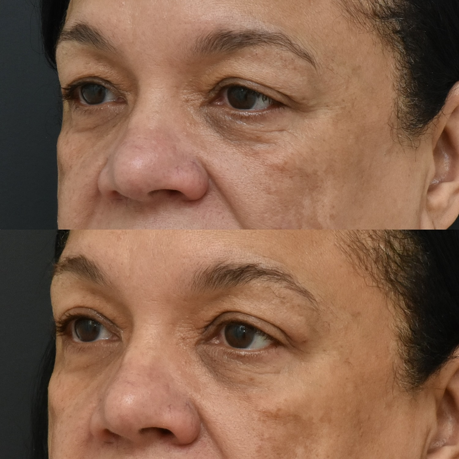 Eyelid Surgery Before & After