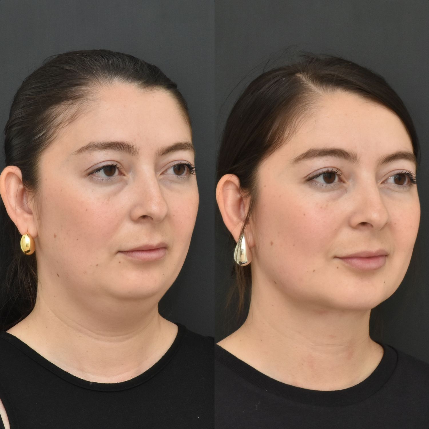 Chin Augmentation Before & After