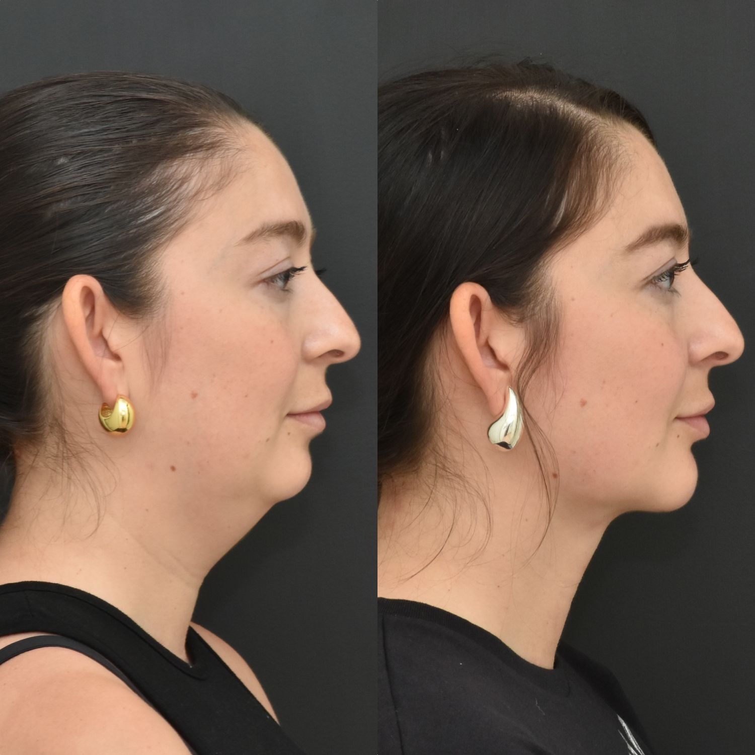 Chin Augmentation Before & After