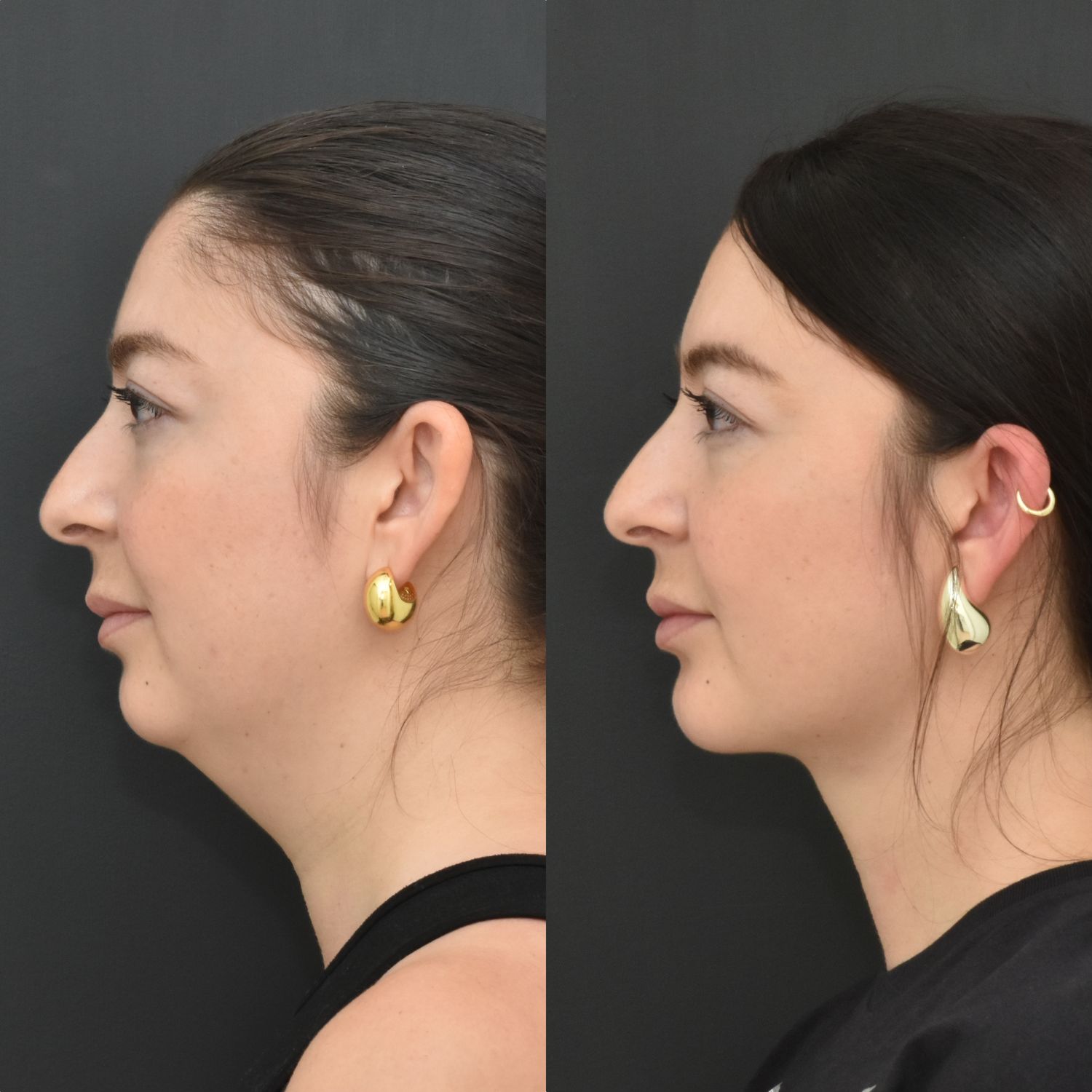Chin Augmentation Before & After