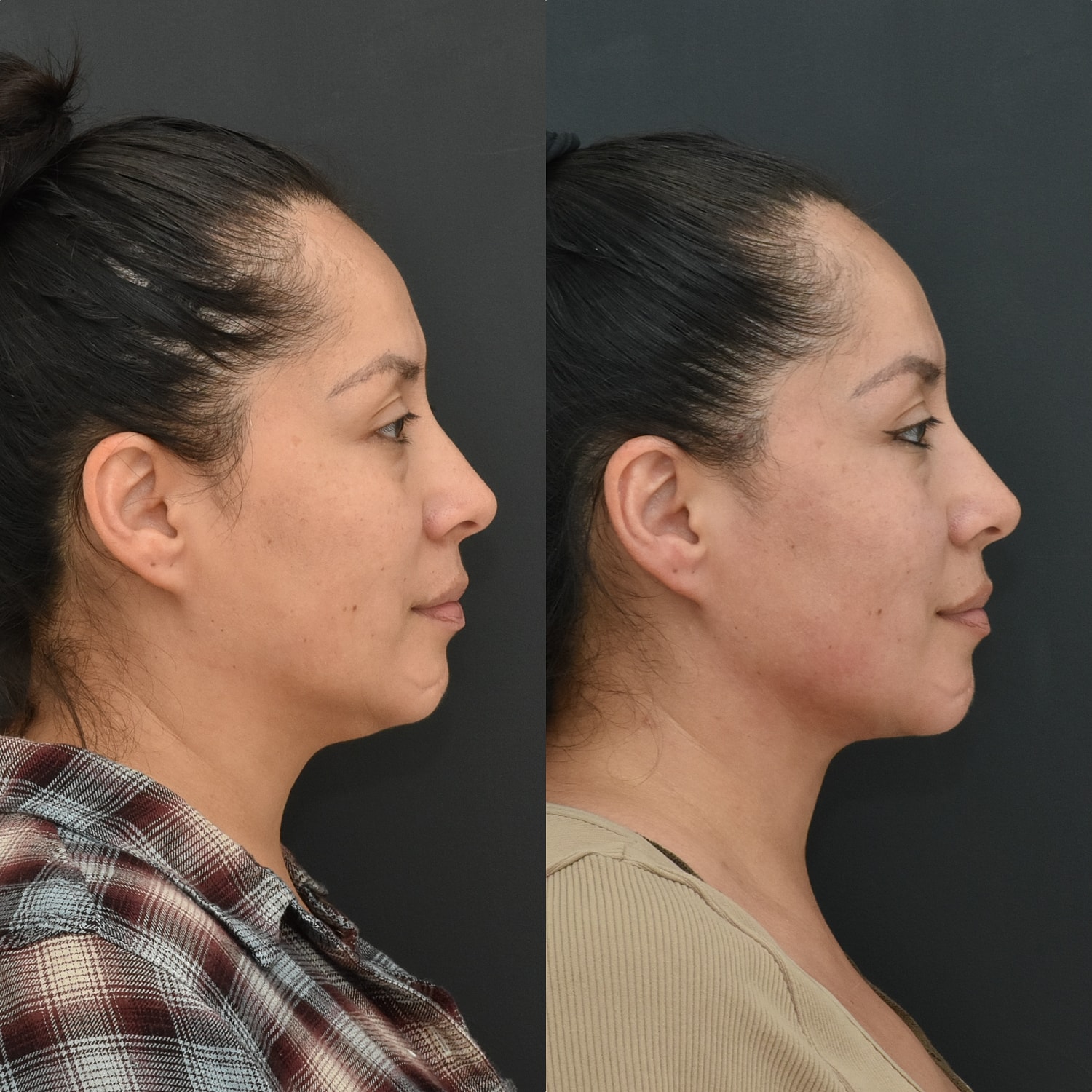Chin Liposuction Before & After