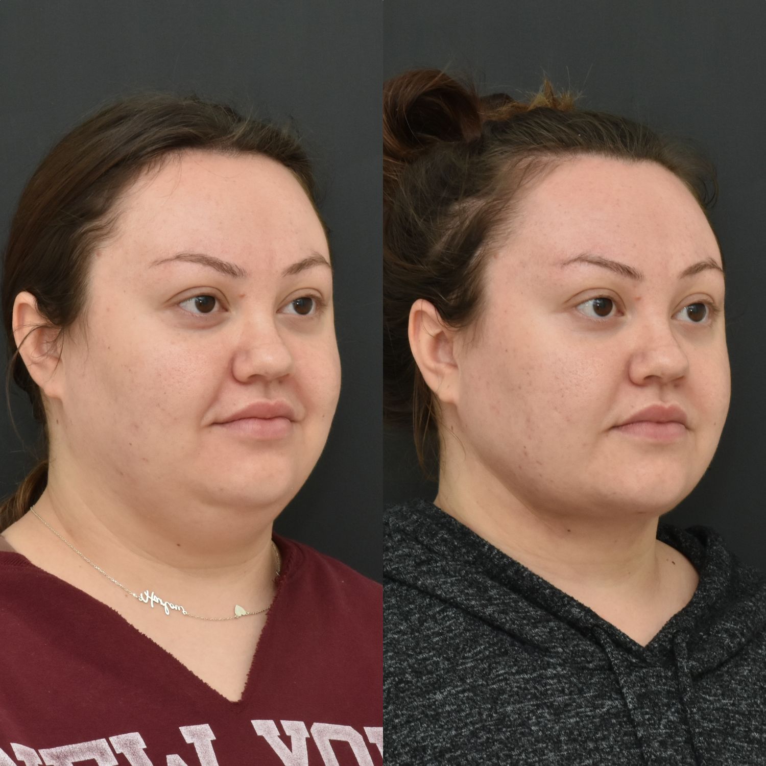 Chin Liposuction Before & After