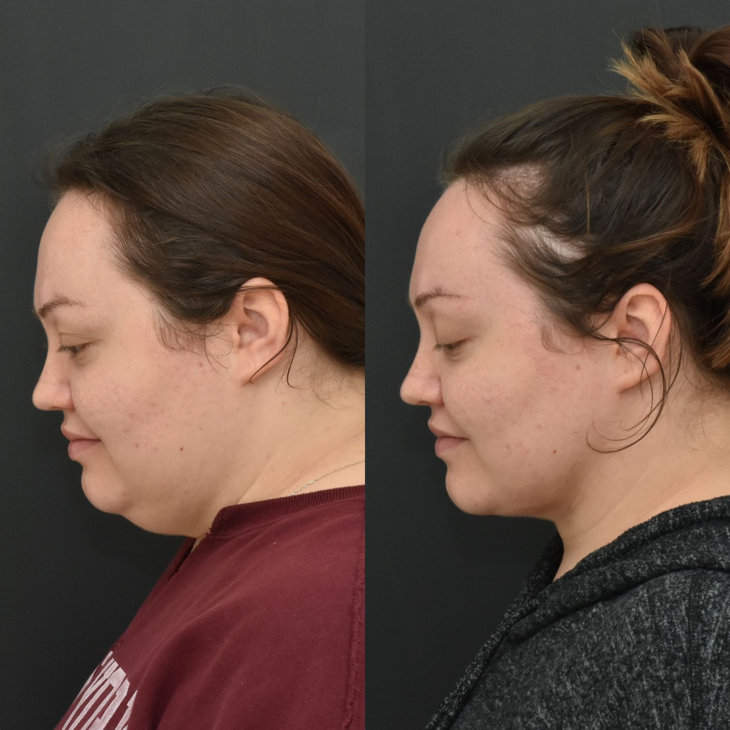 Chin Liposuction Before & After