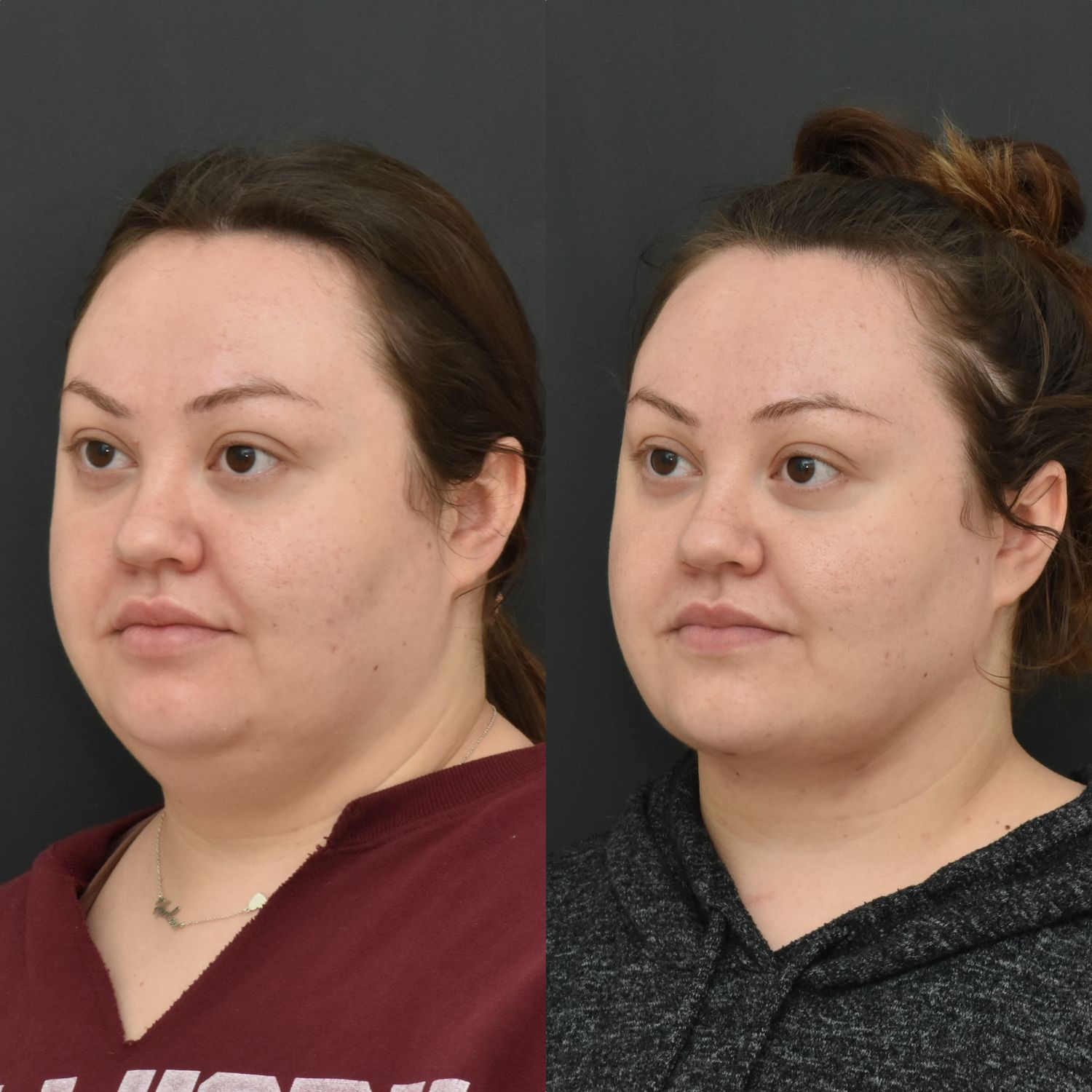 Chin Liposuction Before & After