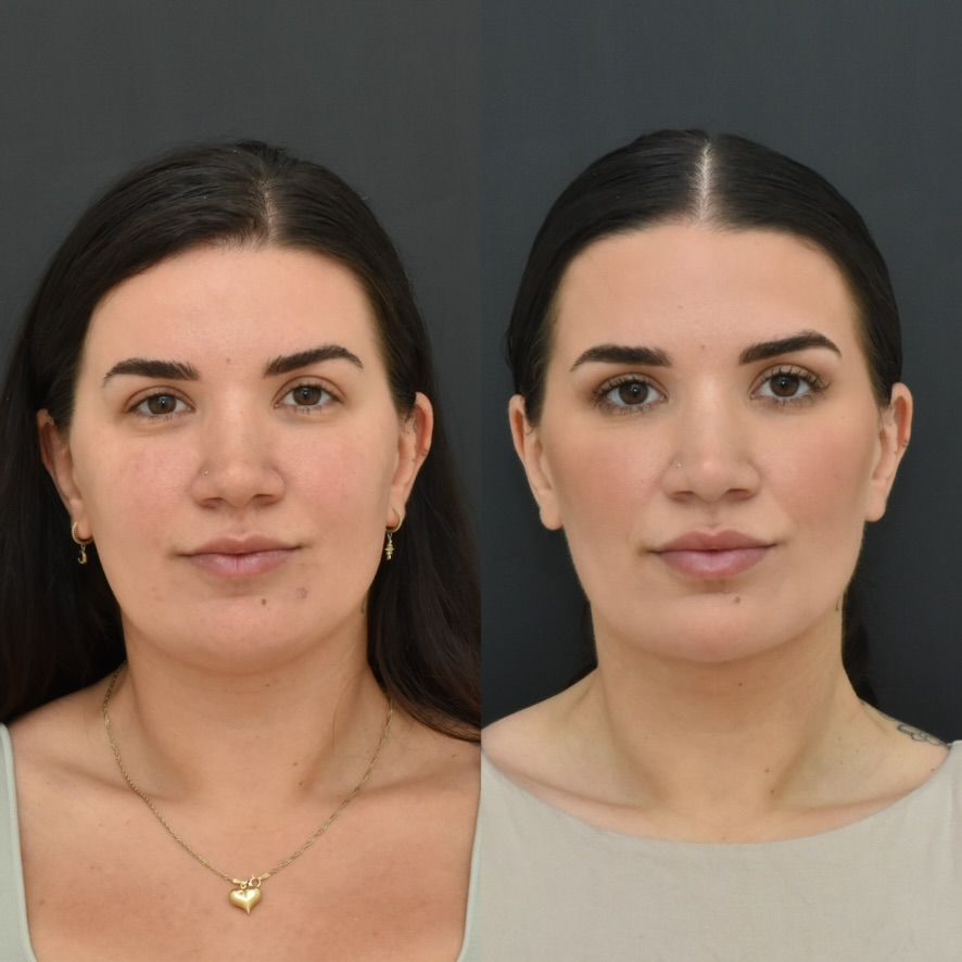 Chin Liposuction Before & After