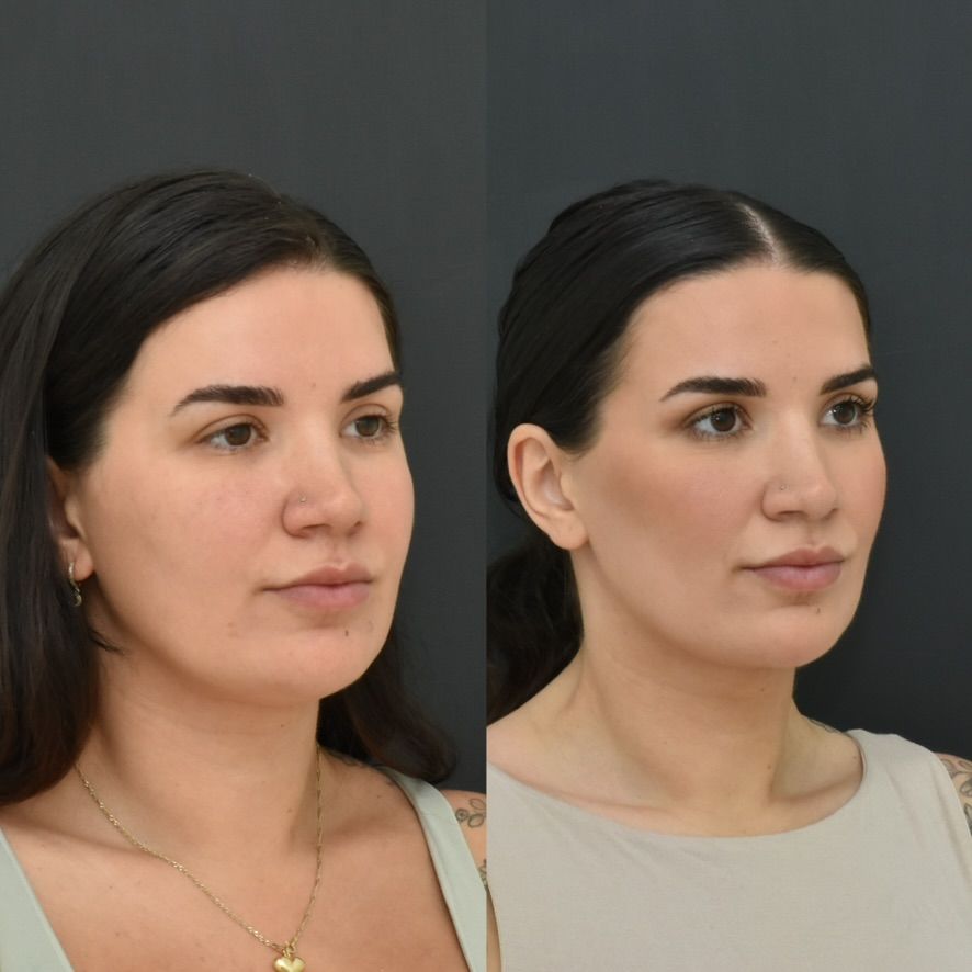 Chin Liposuction Before & After