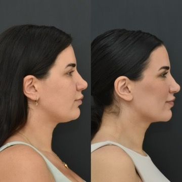 Chin Liposuction Before & After