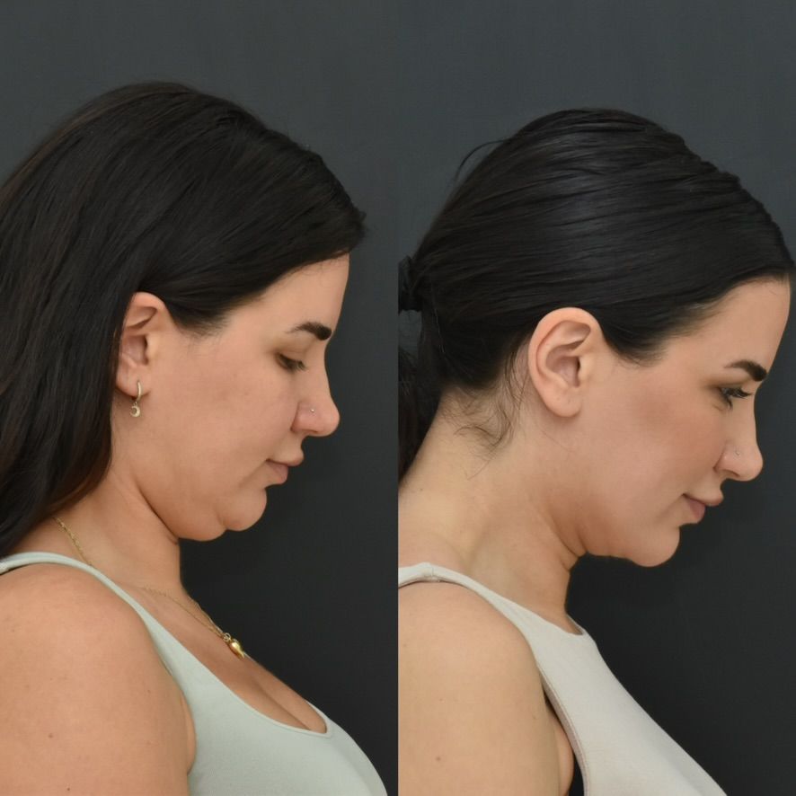 Chin Liposuction Before & After