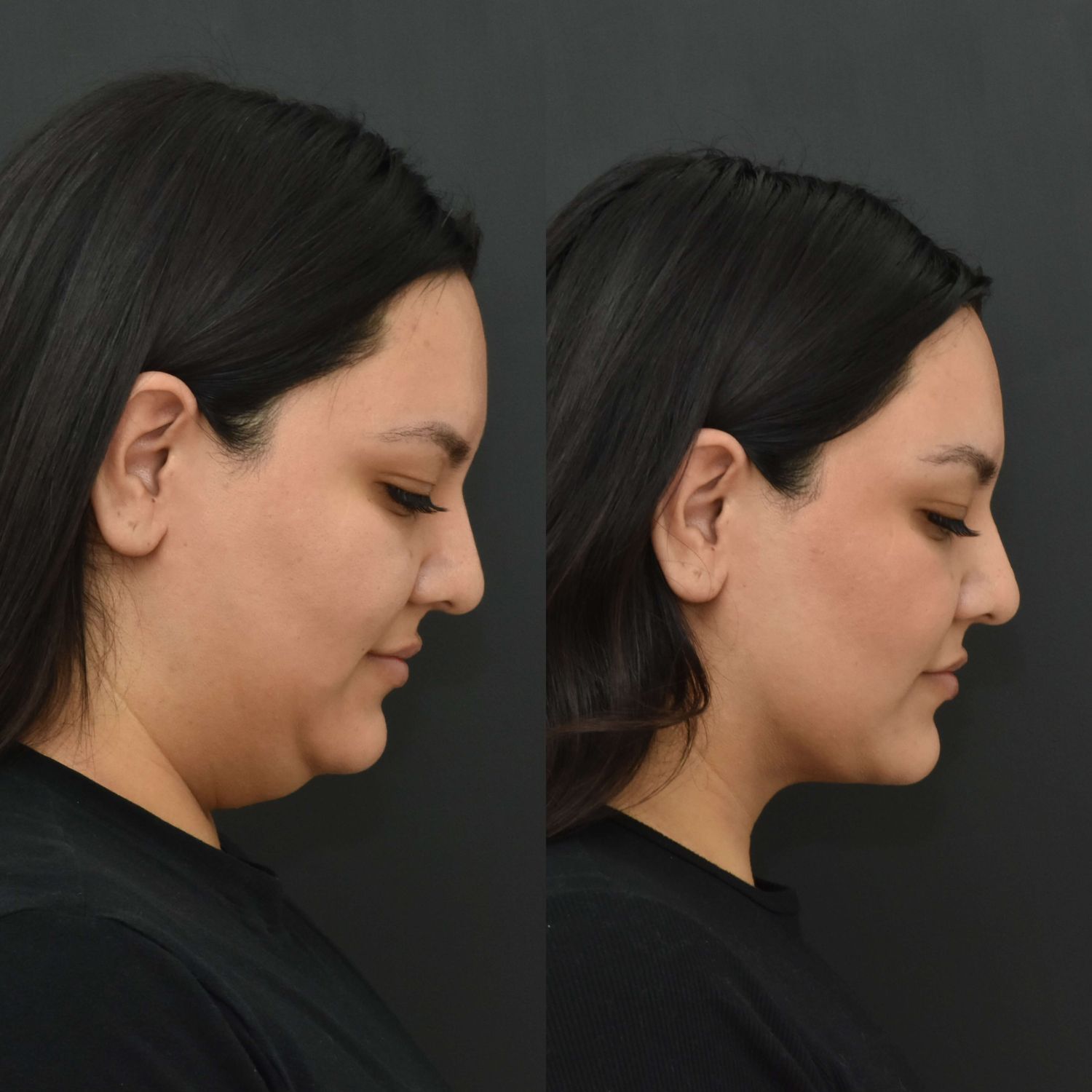Chin Liposuction Before & After