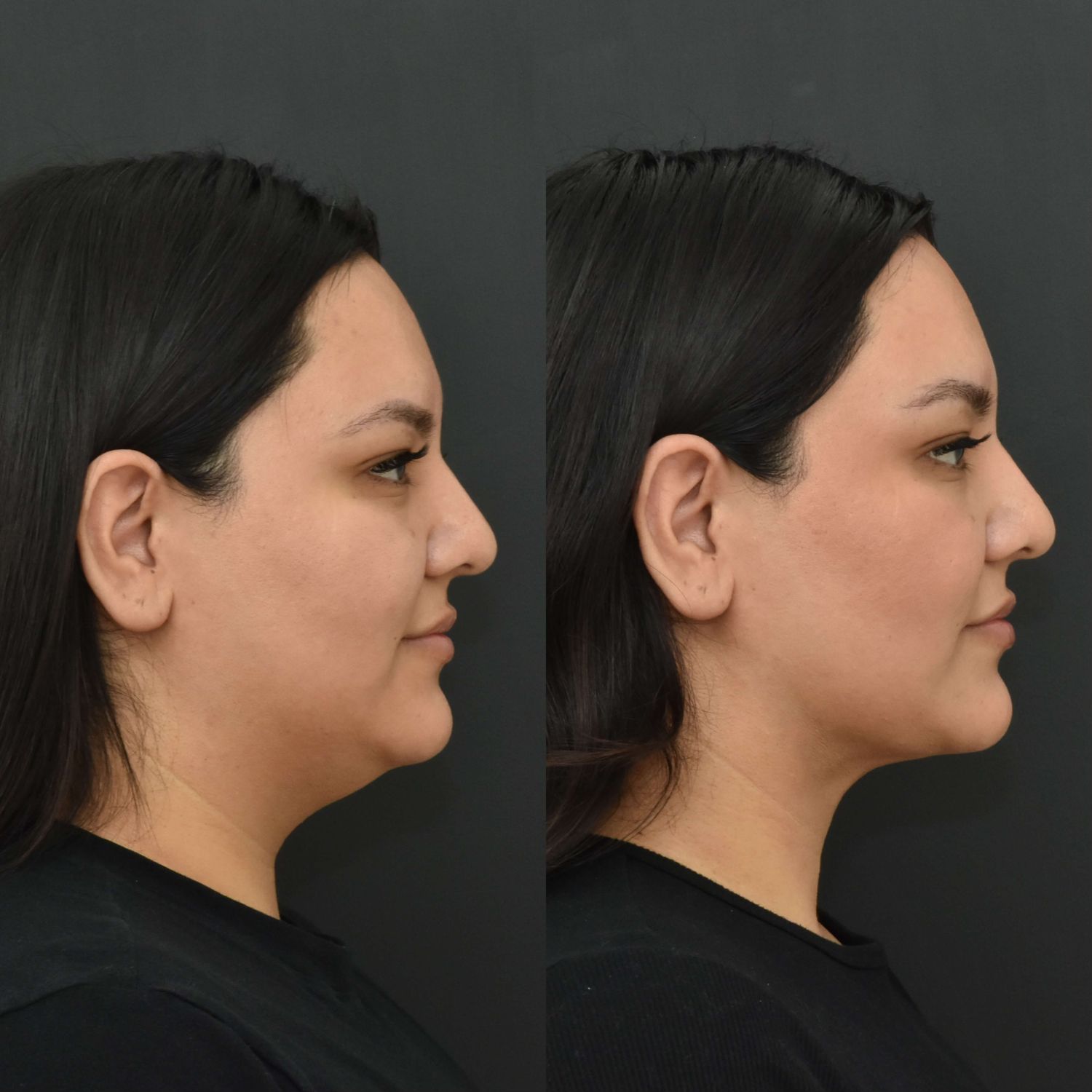 Chin Liposuction Before & After
