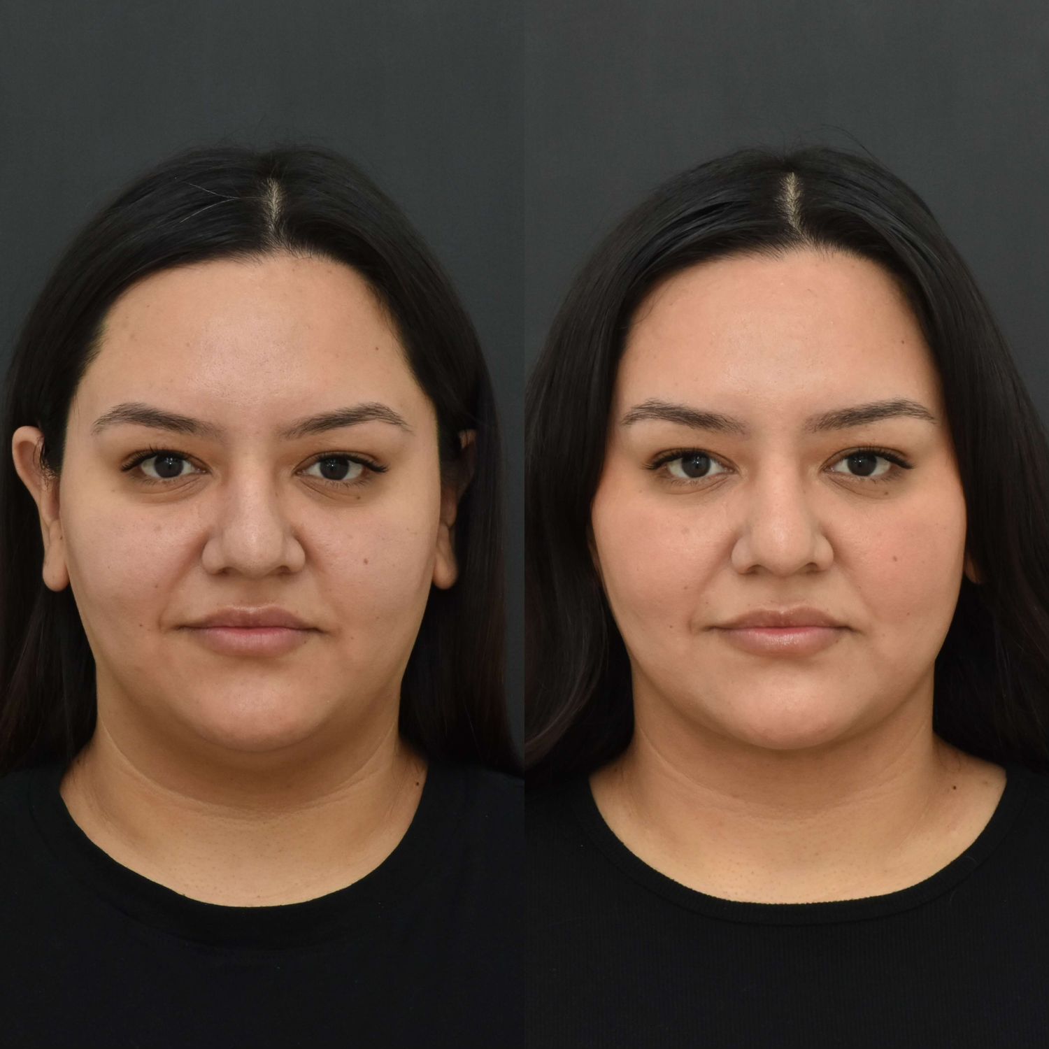 Chin Liposuction Before & After
