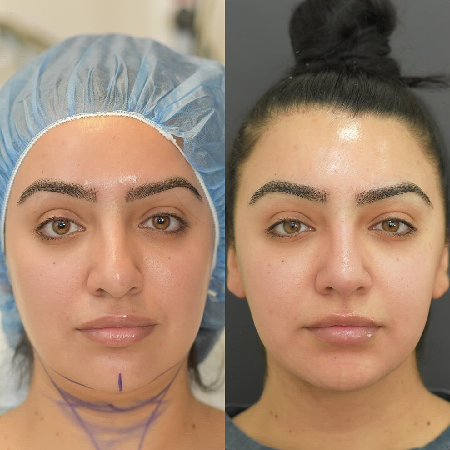 Chin Liposuction Before & After