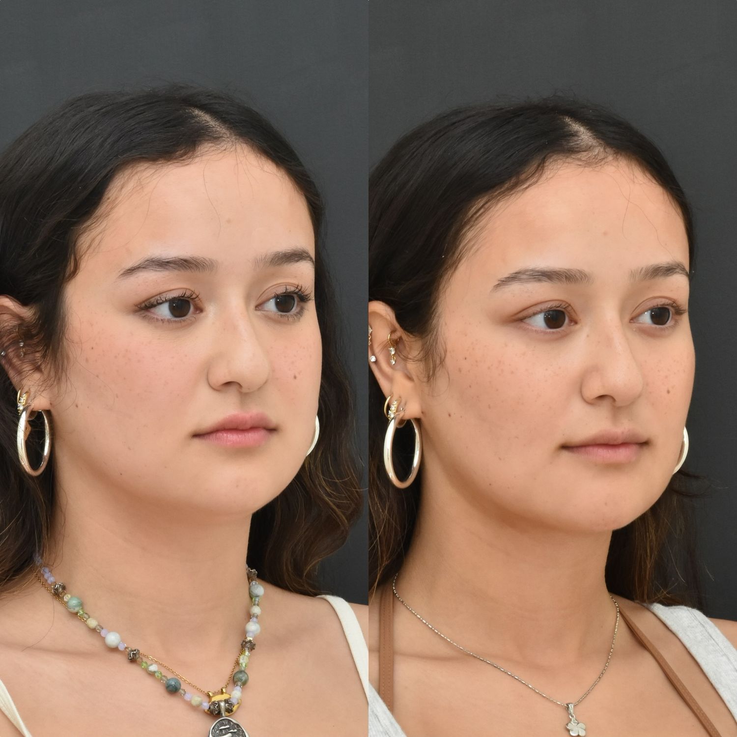 Chin Liposuction Before & After