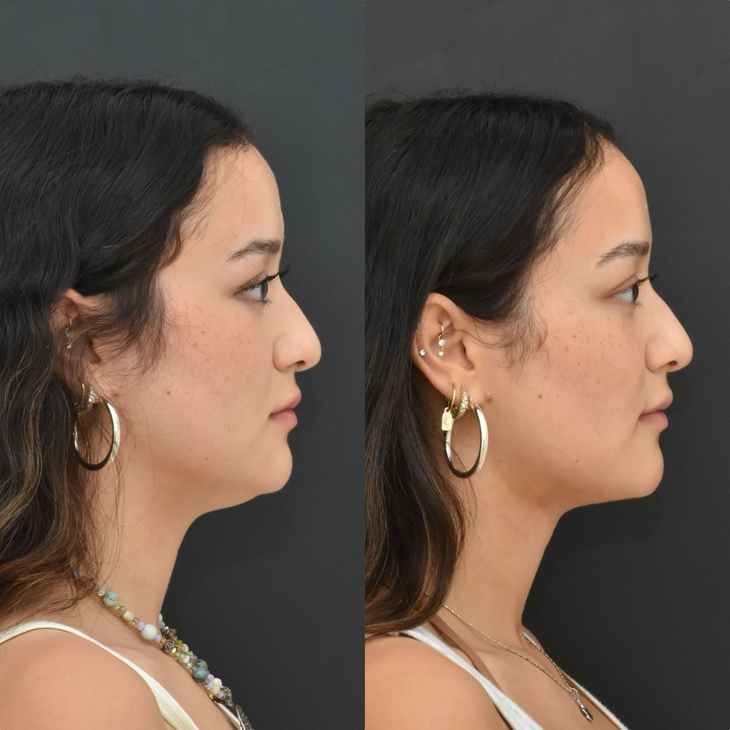 Chin Liposuction Before & After