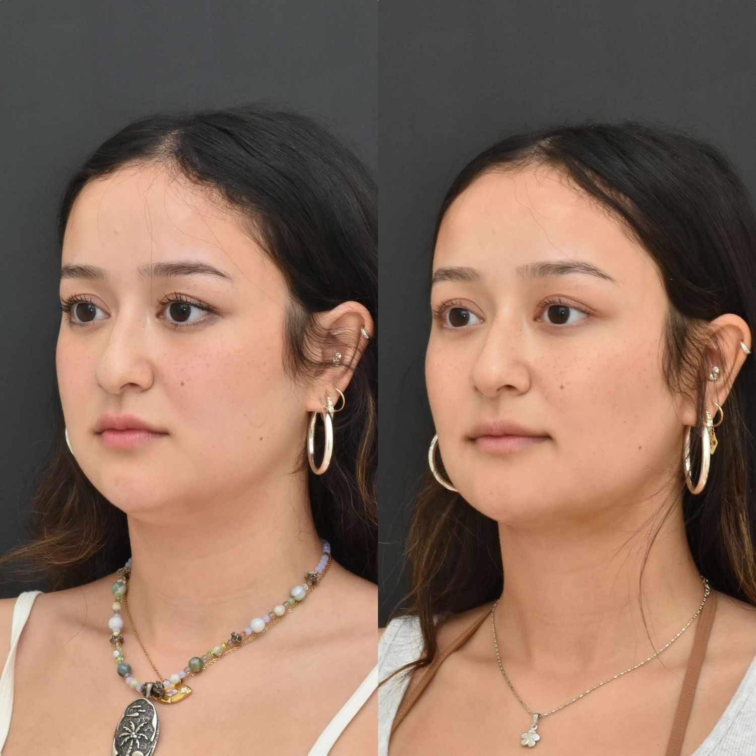 Chin Liposuction Before & After