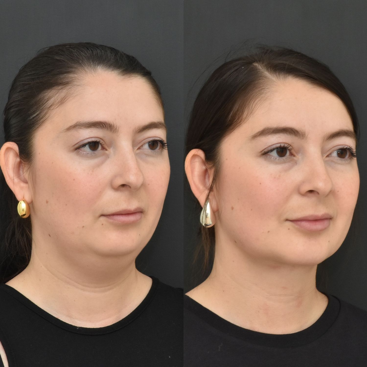 Chin Liposuction Before & After