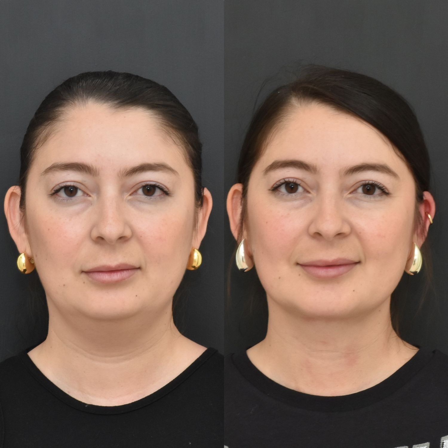 Chin Liposuction Before & After