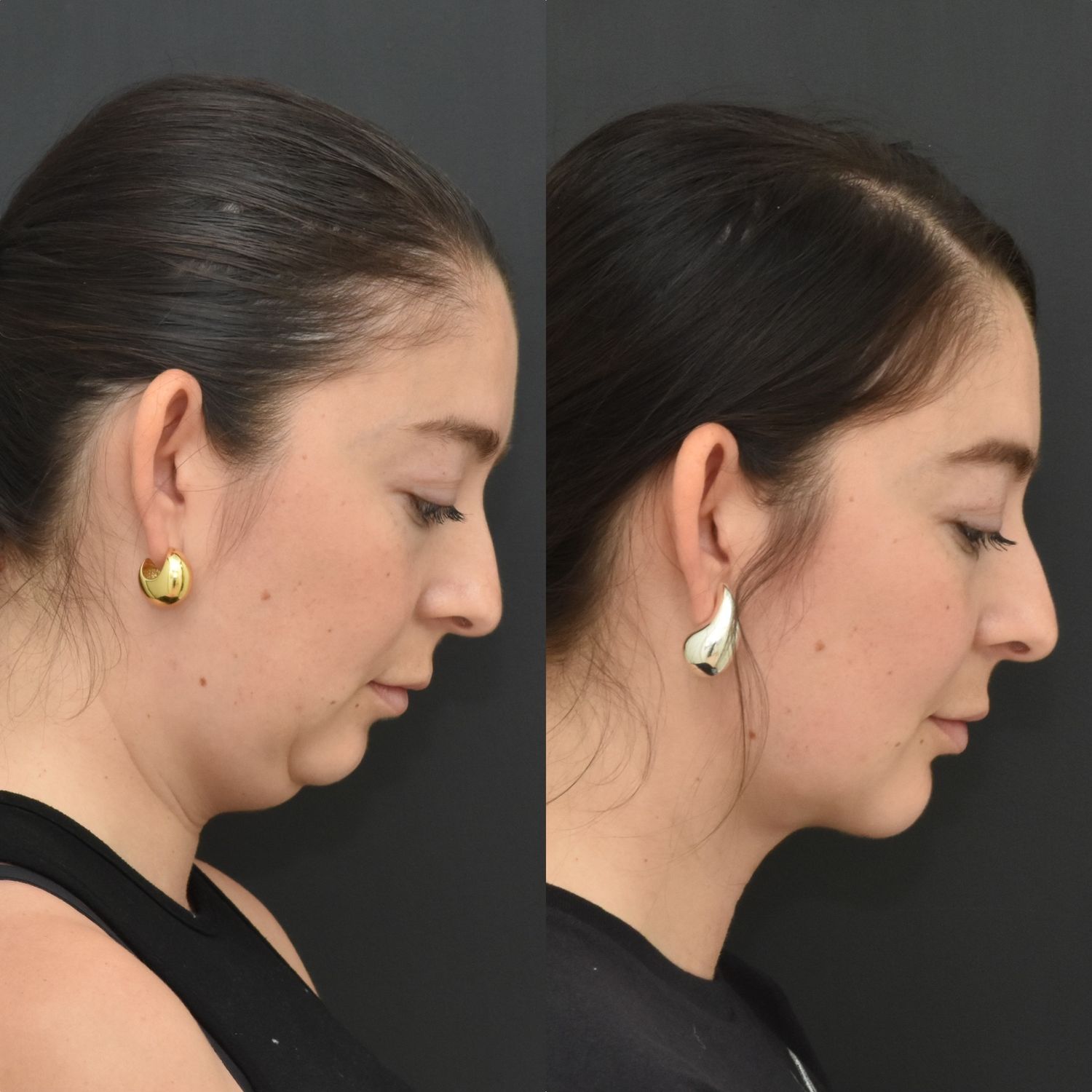 Chin Liposuction Before & After