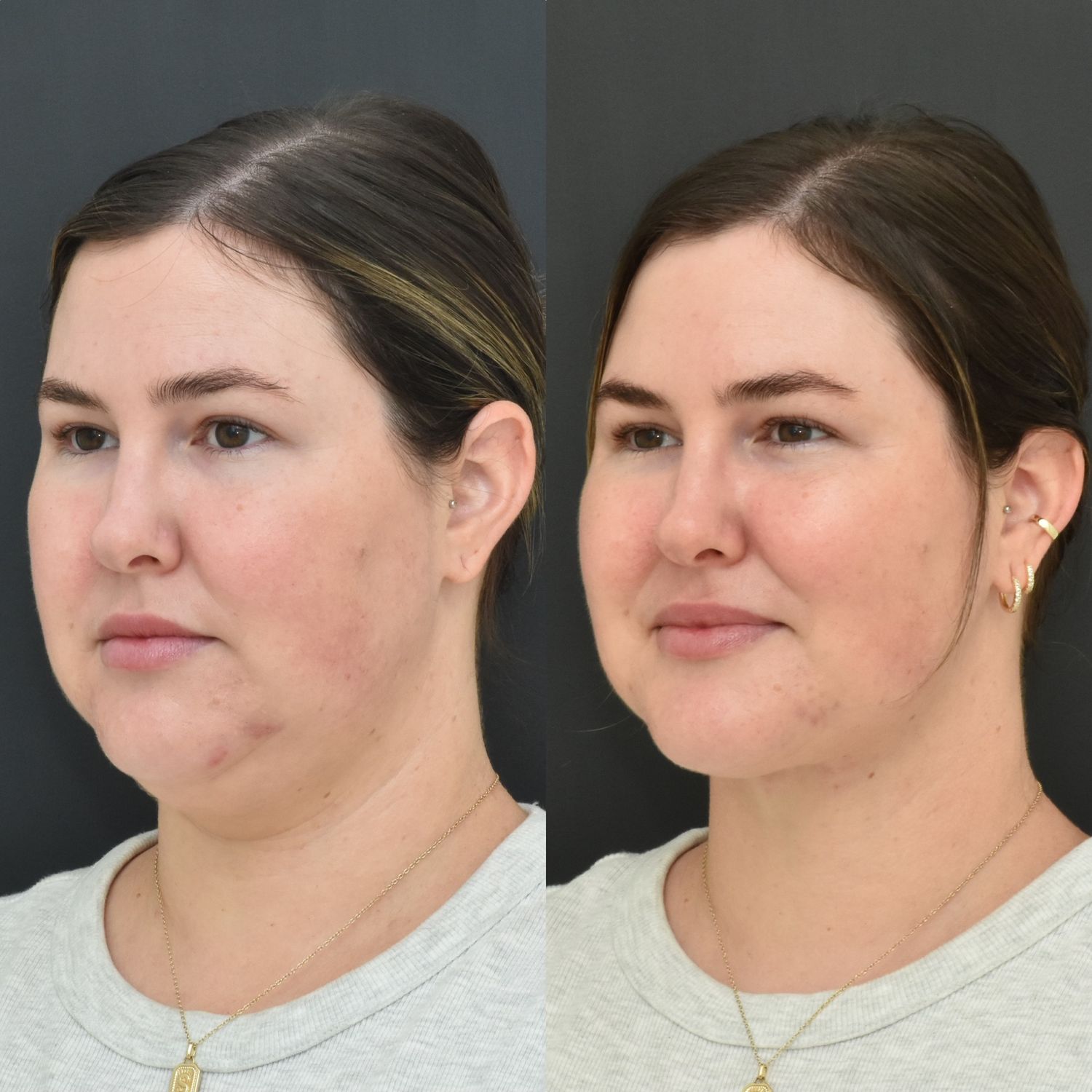 Chin Liposuction Before & After