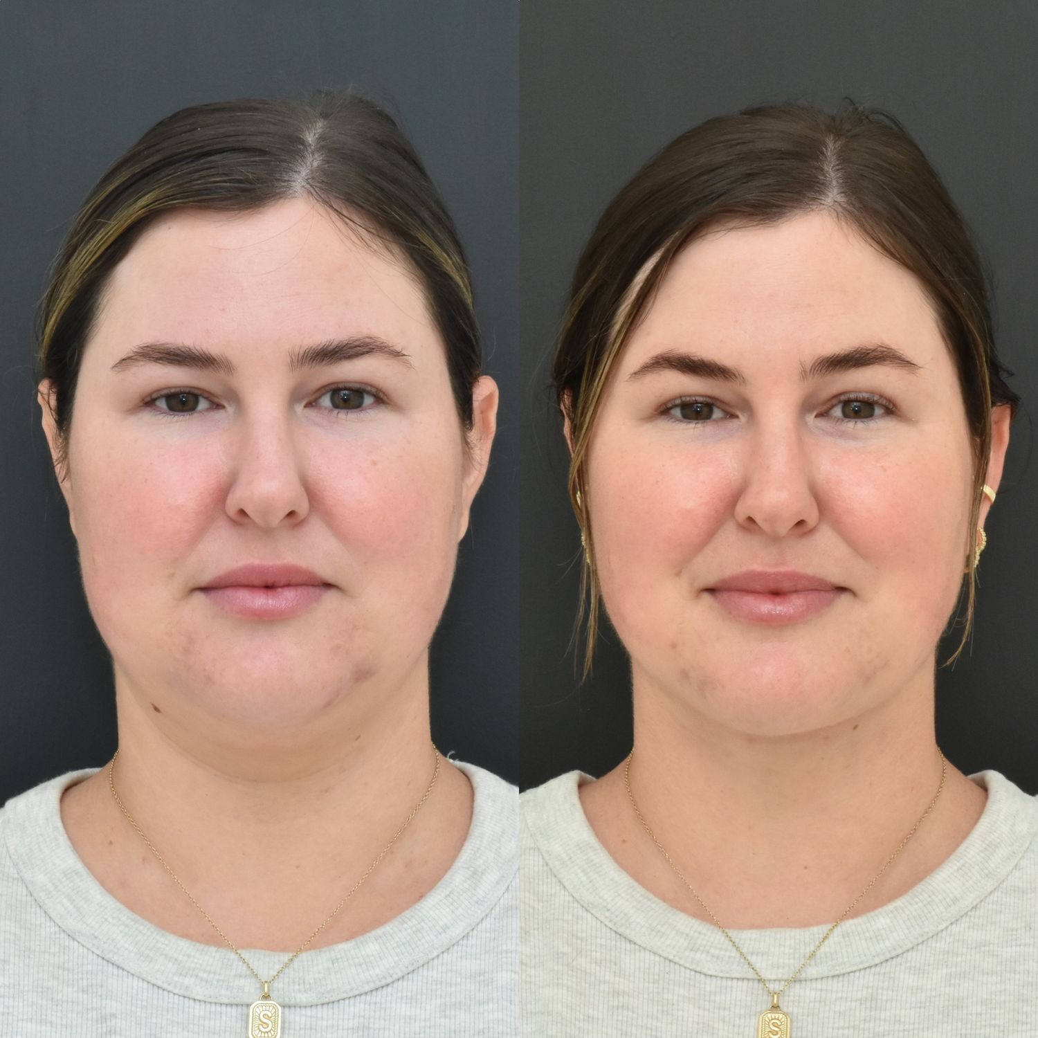 Chin Liposuction Before & After