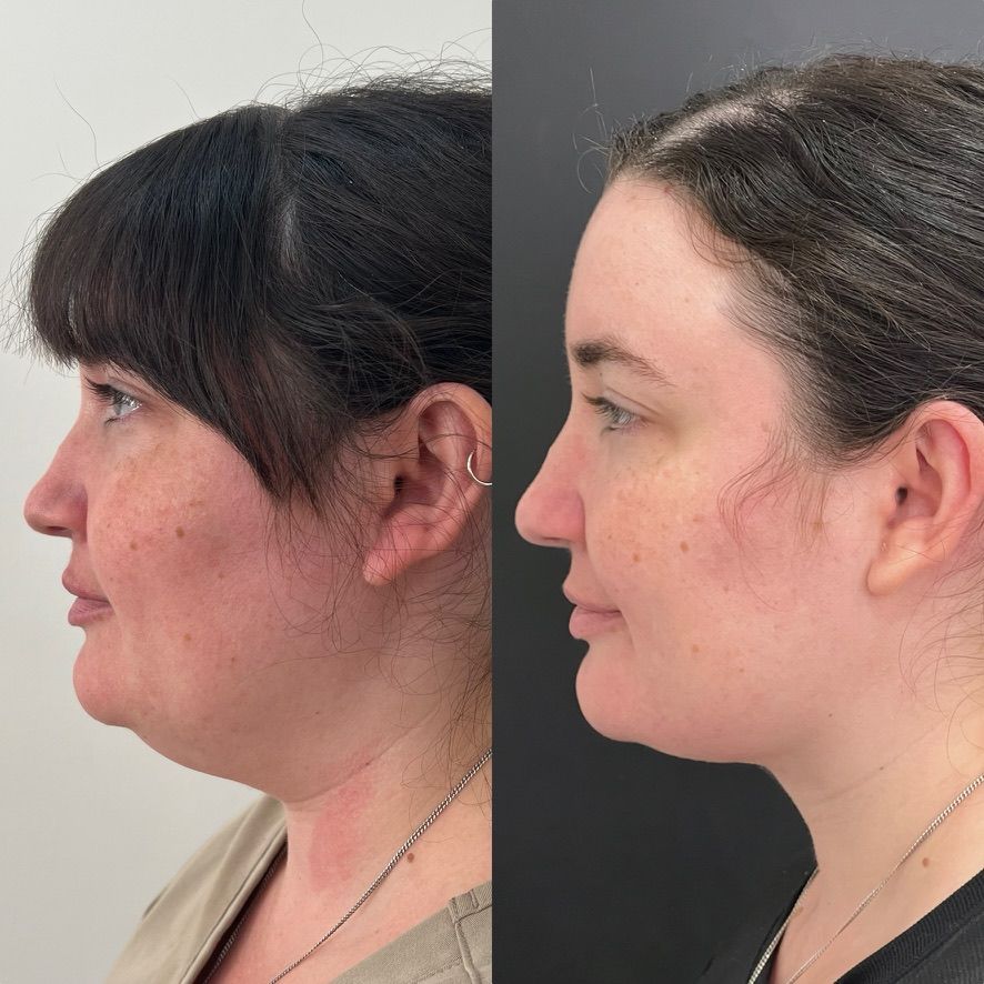 Chin Liposuction Before & After