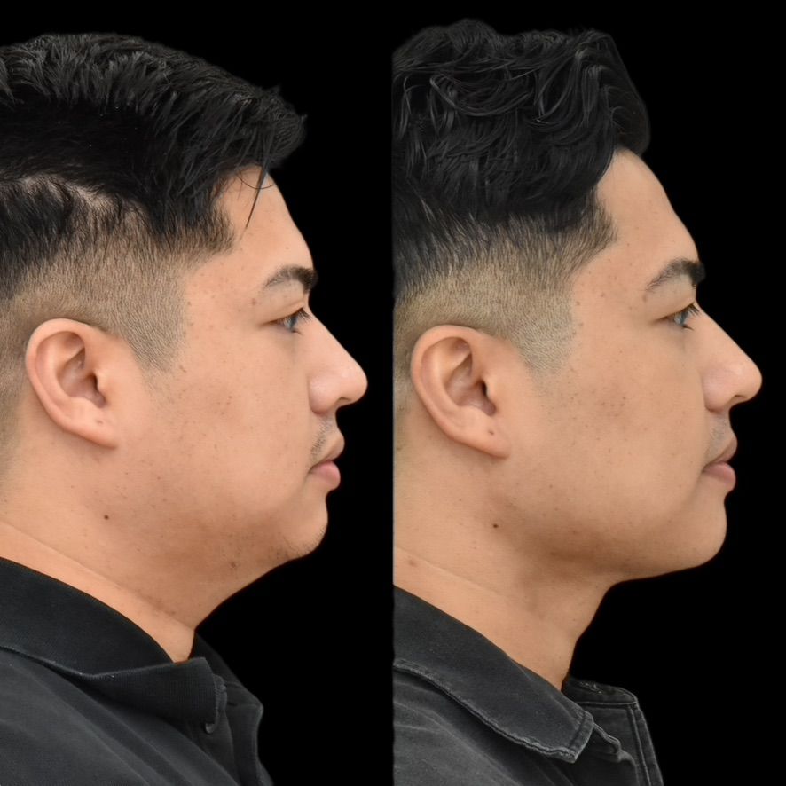 Chin Liposuction Before & After