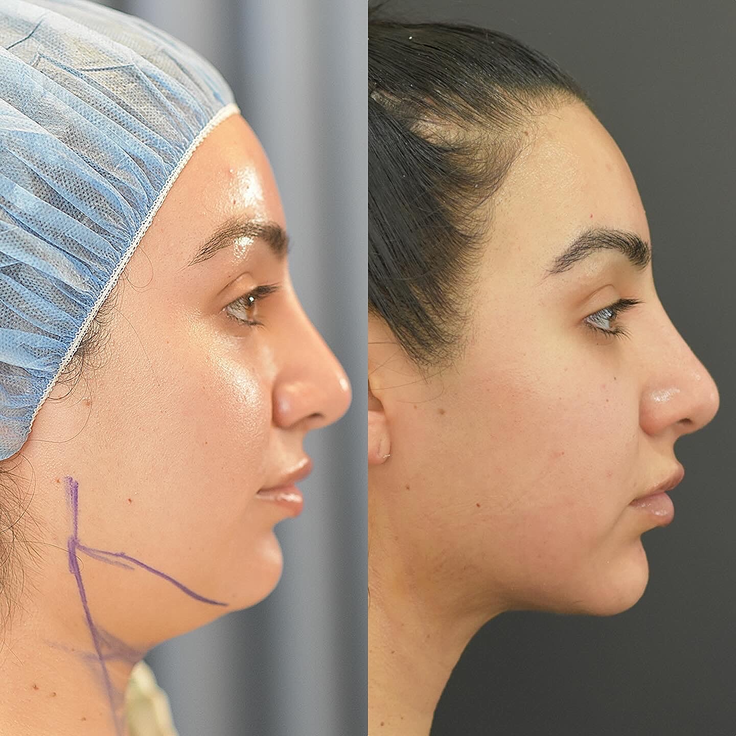 Chin Liposuction Before & After