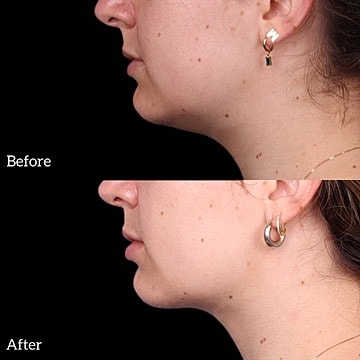 Chin Liposuction Before & After