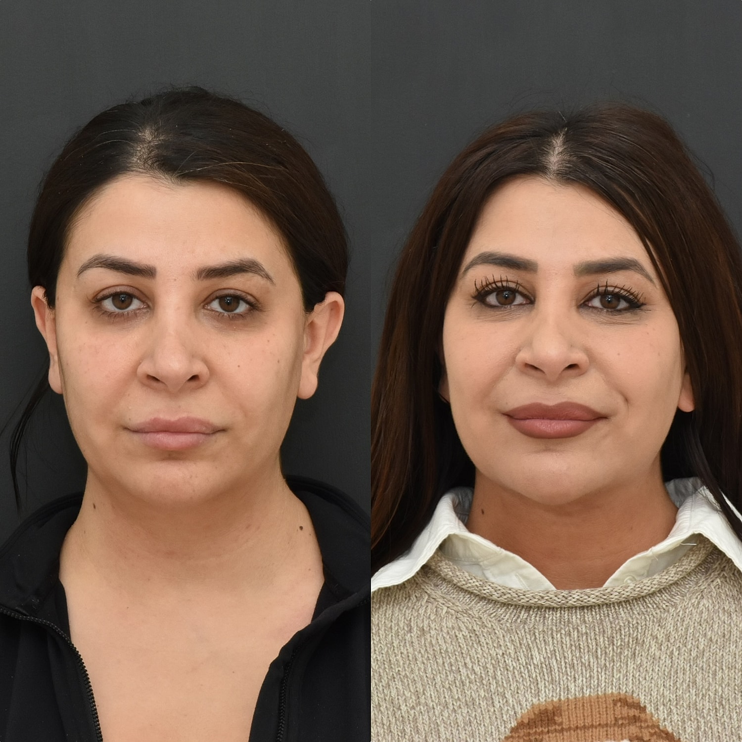 Chin Liposuction Before & After