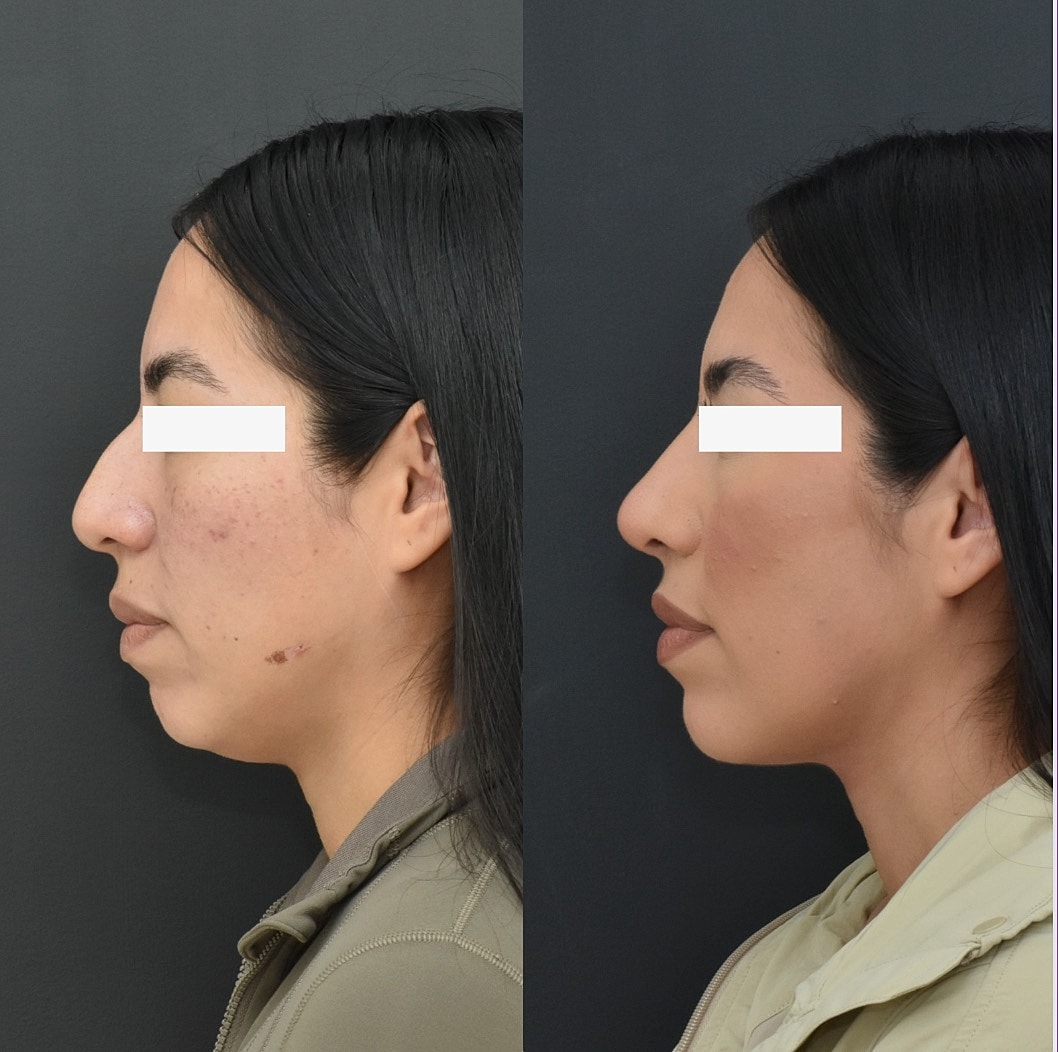 Chin Liposuction Before & After