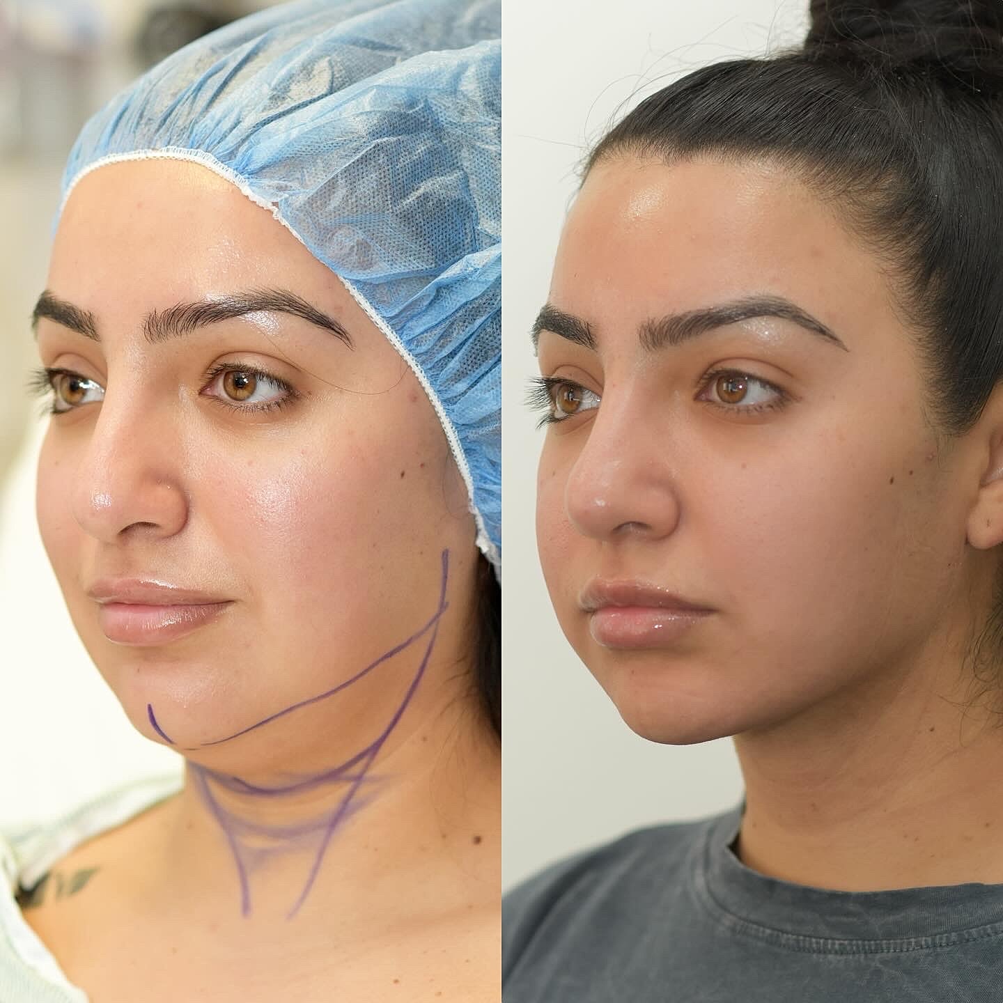 Chin Liposuction Before & After