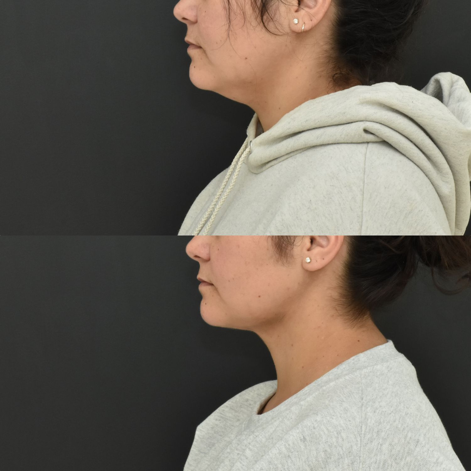 Chin Liposuction Before & After