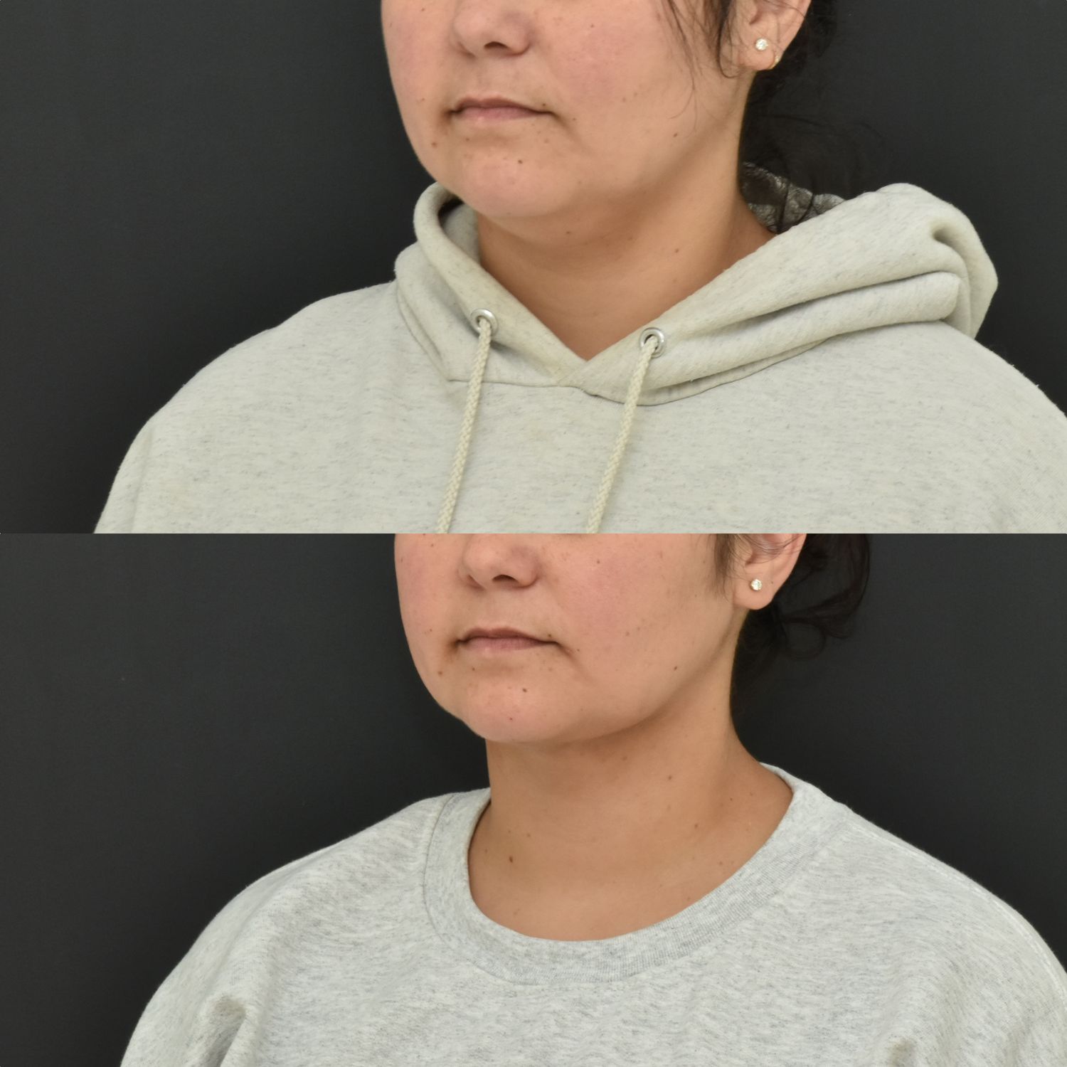 Chin Liposuction Before & After
