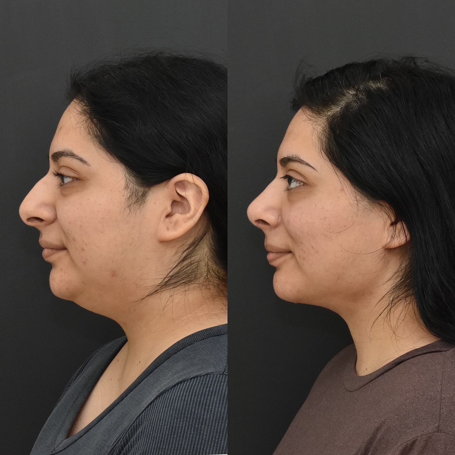 Chin Liposuction Before & After