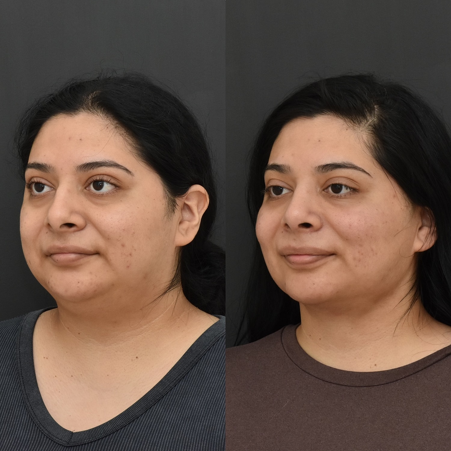 Chin Liposuction Before & After