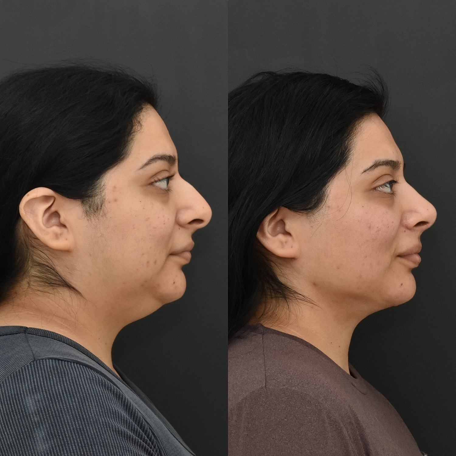 Chin Liposuction Before & After