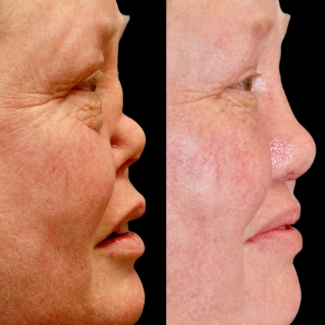 Reconstruction Before & After